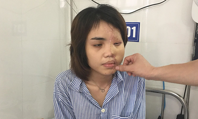 Kỹ thuật tái tạo lại khuôn mặt cho cô gái bị hôn phu tạt axit
