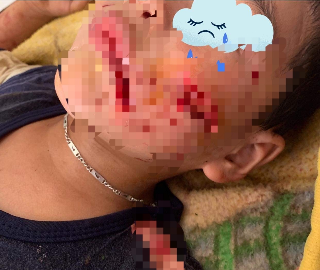 Bé trai 5 tuổi ở Sơn La bị chó nhà cắn vào đầu, mặt