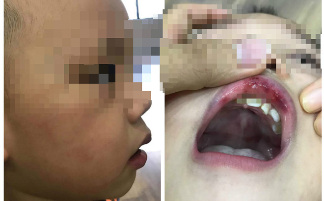 Thông tin mới vụ cô giáo tát trẻ 3 tuổi bầm tím mặt, tụ máu môi