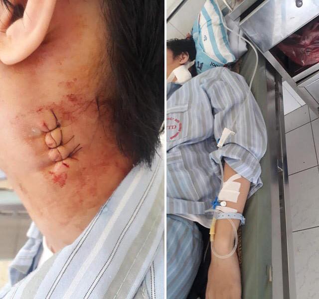 Hà Nội: Bác sĩ Bệnh viện Bạch Mai 'mổ nhầm' gây biến chứng cho bệnh nhân?