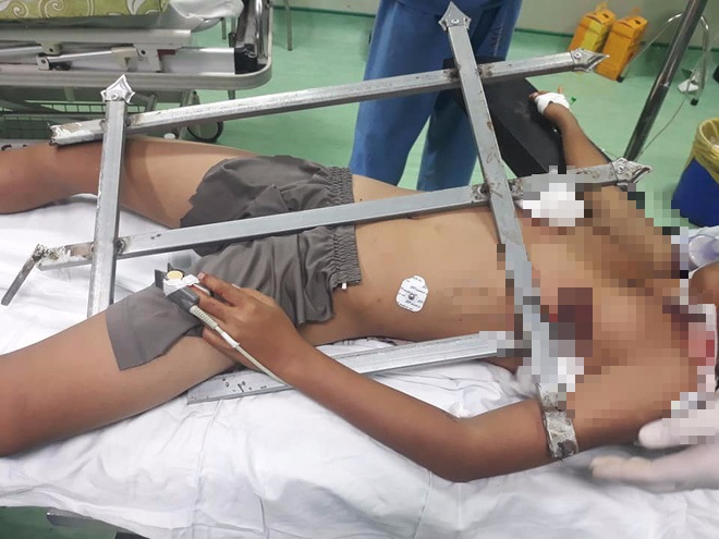 Bé trai 13 tuổi ở Nghệ An bị mũi sắt nhọn hàng rào đâm xuyên ngực