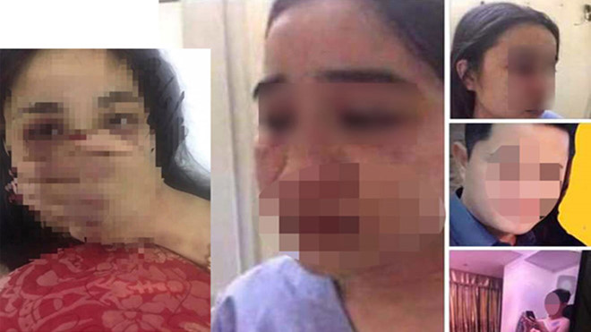 Bộ Y tế yêu cầu làm rõ vụ nữ điều dưỡng bị bác sĩ đánh đập ở Thừa Thiên-Huế