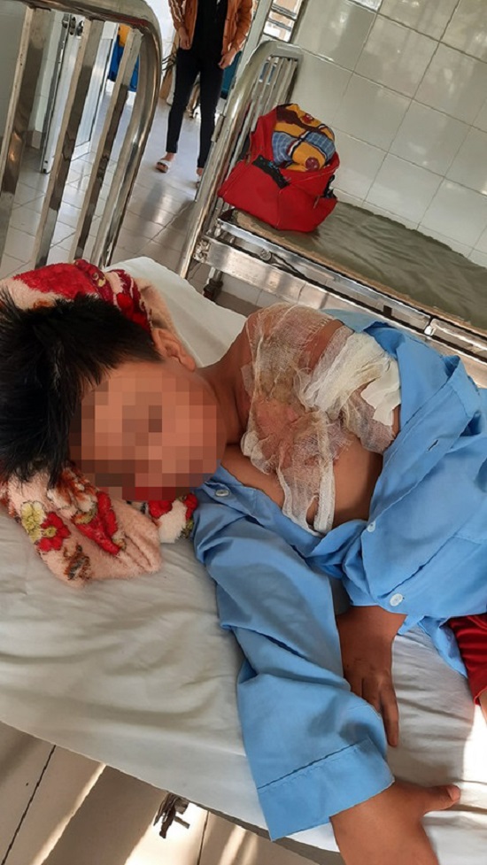 Thanh Hóa: Bé trai 11 tuổi bị cha tạt nước sôi