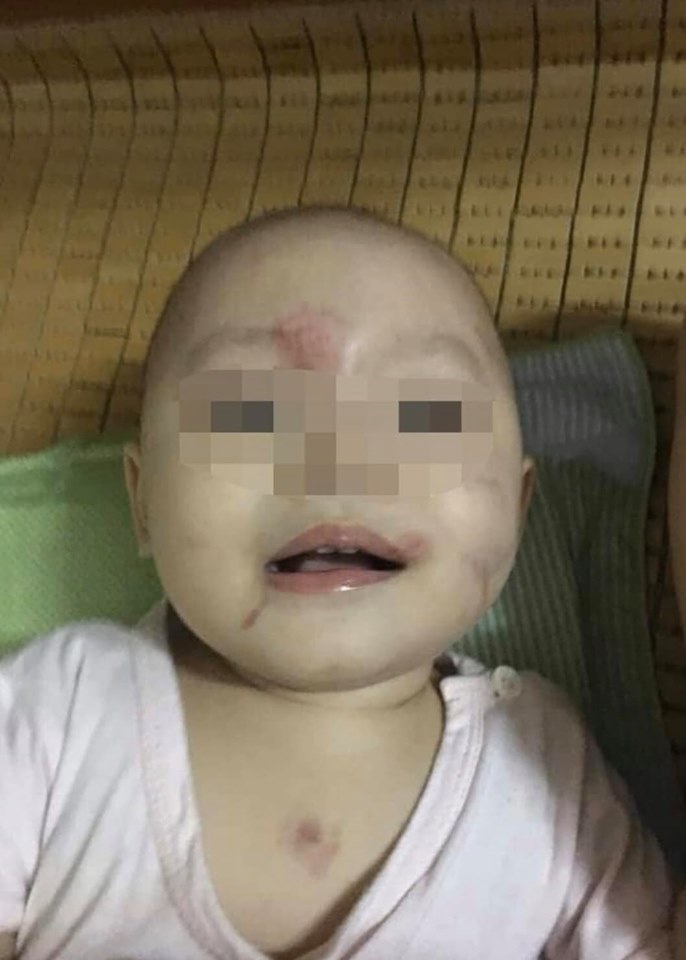 Thông tin chính thức vụ bé gái 14 tháng tuổi bị bầm tím vùng mặt ở Hải Phòng