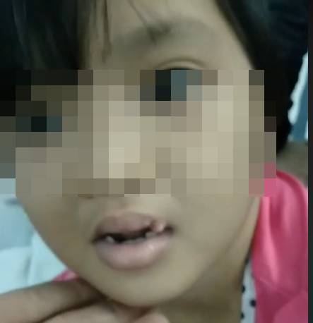 Bé gái 6 tuổi bị cha dượng châm tàn thuốc, bạo hành cơ thể