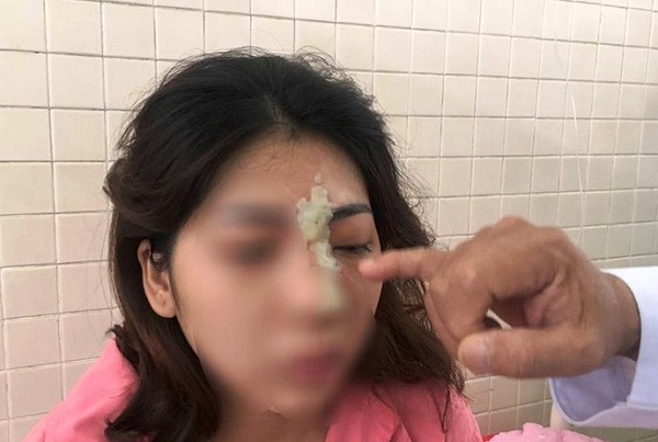 Cô gái 21 tuổi ở Bình Phước bị mù mắt vì tiêm filler nâng mũi tại spa