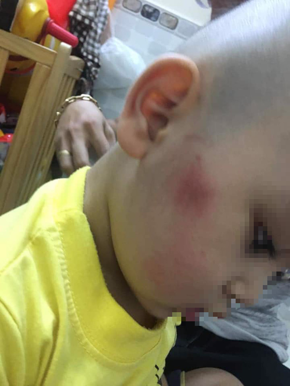 Đà Nẵng: Kỷ luật 2 cô giáo đánh vào má, mông trẻ nhưng nói dối là ngã