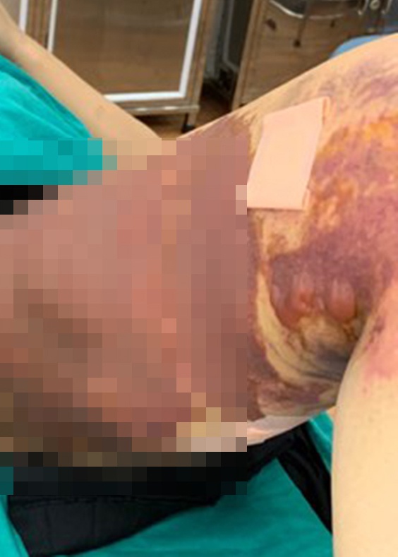 Cô gái bị hoại tử da sau khi hút mỡ tại Thẩm mỹ viện Việt Hàn