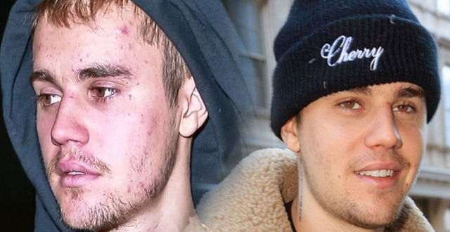 Justin Bieber tiết lộ cùng lúc anh bị mắc hai căn bệnh vô cùng đáng sợ