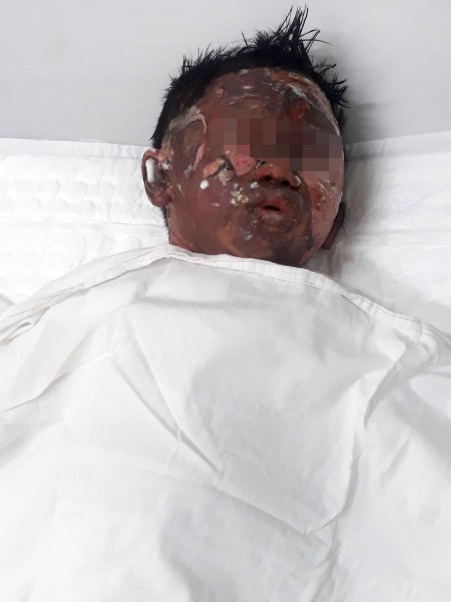 Tình hình sức khỏe của bé 6 tuổi bị dì ruột đốt bằng xăng ở Bà Rịa - Vũng Tàu