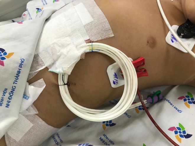 Bé trai 2,5 tuổi nhập viện cấp cứu sau khi uống nhầm hóa chất trong chai nước