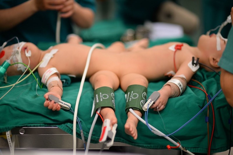 Phẫu thuật tách cặp song sinh: 5 ê-kip bác sĩ đổi ca liên tục