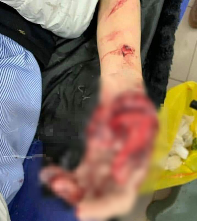 Yên Bái: Điện thoại phát nổ khi đang sạc, nam sinh dập nát bàn tay