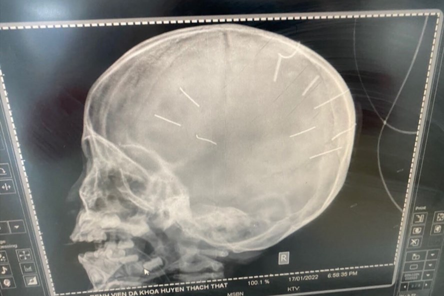 Hà Nội: Bé gái 3 tuổi nghi có 9 đinh găm vào đầu, có dấu hiệu bị bạo hành