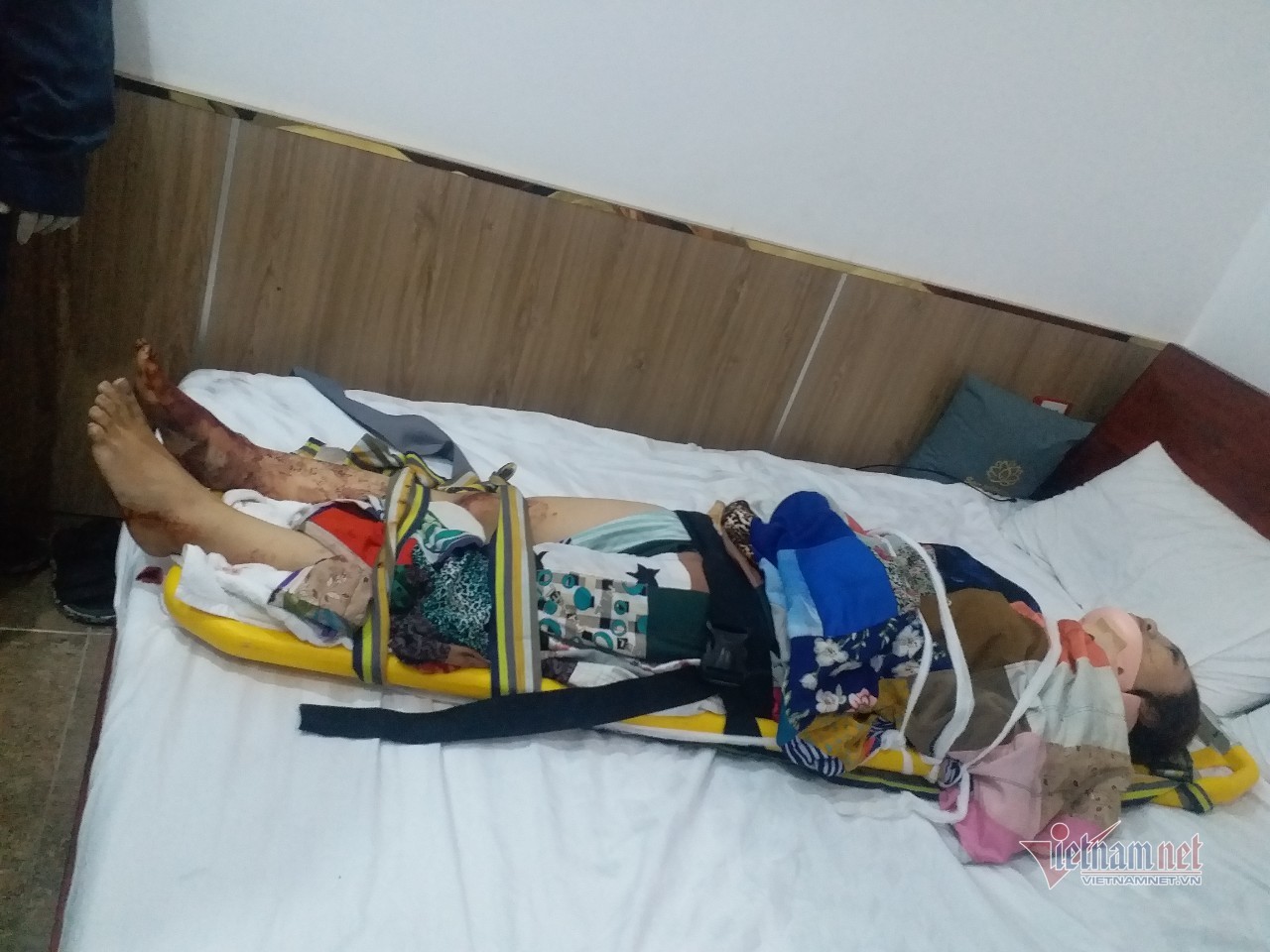 TP.HCM: Rơi thang máy trong khách sạn, cô gái bị chấn thương cột sống