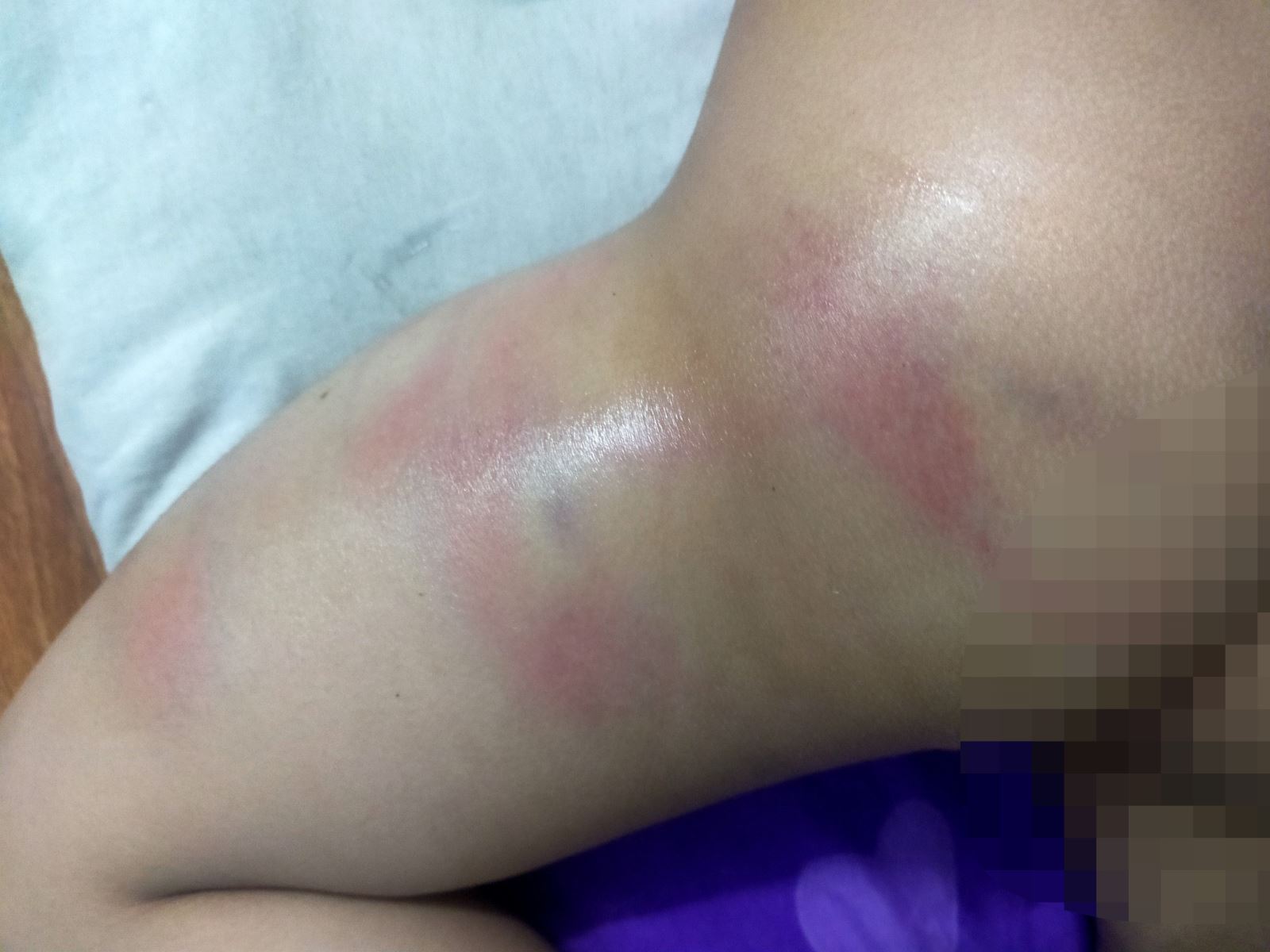 Bình Dương: Bé gái 4 tuổi nghi bị cô giáo đánh bầm tím