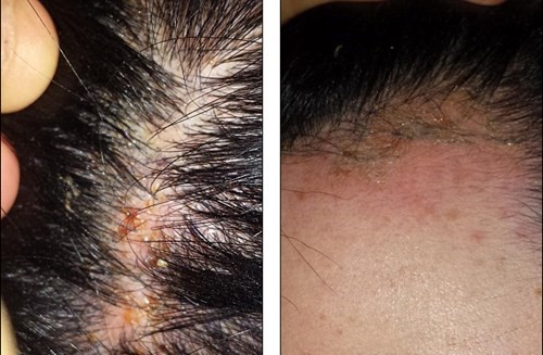 Dầu gội phủ bạc Ric Hair – Giải pháp tối ưu hạn chế tác hại của thuốc nhuộm tóc