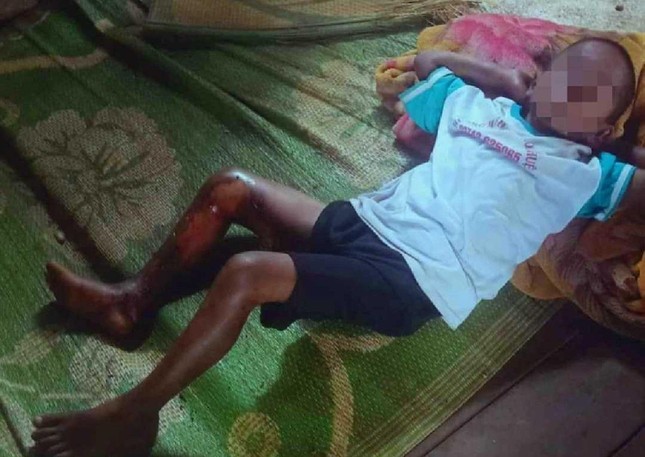 Đắk Lắk: Điều tra nghi án bé trai bị tẩm xăng đốt vì không chịu đi trộm mủ cao su