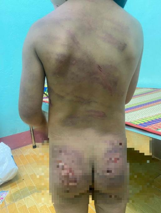 Bình Phước: Xác minh vụ bé gái nghi bị bạo hành với nhiều vết bầm tím trên người