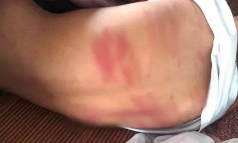 Mẹ ruột lên tiếng vụ nam sinh lớp 8 bị bố đánh bầm dập lưng, ngất xỉu tại lớp