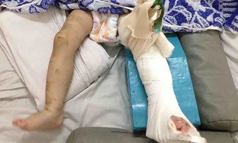 Tức giận vì quấy khóc mẹ nuôi đánh bé gái một tuổi gãy chân