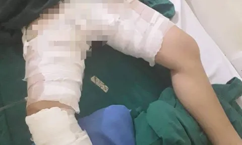 Bác sỹ sơ ý trong quá trình phẫu thuật khiến cồn làm bỏng bệnh nhân