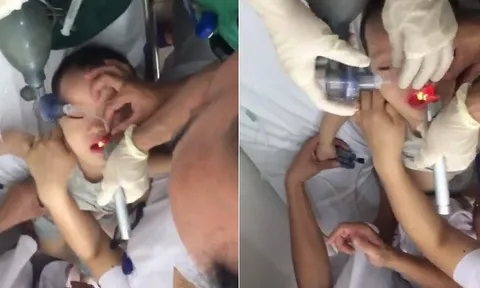 Hóc thạch rau câu, bé trai 2 tuổi ngưng thở