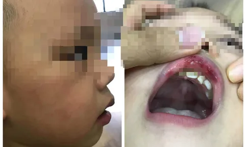 Thông tin mới vụ cô giáo tát trẻ 3 tuổi bầm tím mặt, tụ máu môi