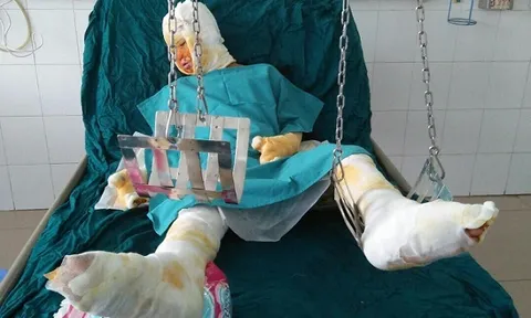 Nạn nhân duy nhất còn sống trong vụ tẩm xăng đốt cả gia đình ở Sơn La