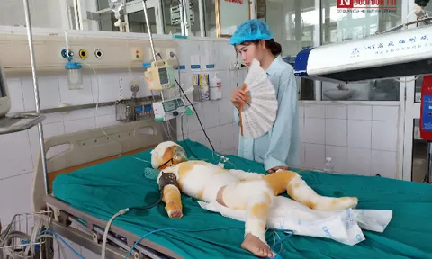 Tình hình sức khỏe của 3 bé bị bỏng cồn tại lớp trẻ mầm non