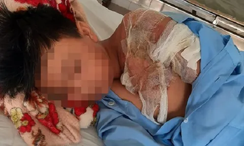 Thanh Hóa: Bé trai 11 tuổi bị cha tạt nước sôi