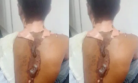 Nam thanh niên bị chị gái tạt nước sôi bỏng nặng phải nhập viện
