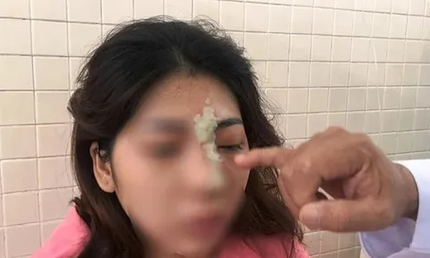 Cô gái 21 tuổi ở Bình Phước bị mù mắt vì tiêm filler nâng mũi tại spa