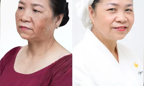 Lối thoát nào cho chị em nám nặng, mất sắc tố, nền da bị phá hủy?