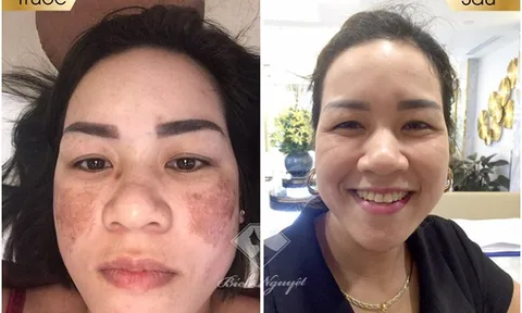 Rũ bỏ gương mặt nhọ nồi cho bà mẹ 2 con bị nám 'ám quẻ' nhờ Phác đồ trị nám tại nhà Bích Nguyệt Lullaby