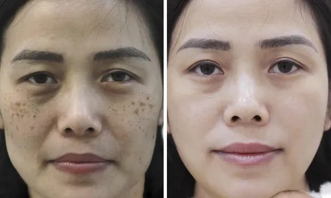 Chị khách U35 vỡ òa hạnh phúc khi trị nám thành công tại nhà với phác đồ Bích Nguyệt Lullaby