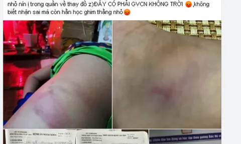 Giáo viên chủ nhiệm bị phụ huynh tố cáo đánh học sinh bầm tím
