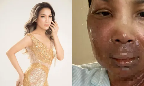 Hồng Ngọc bất ngờ công khai hình ảnh bị bỏng 2/3 gương mặt vì nổ nồi xông hơi