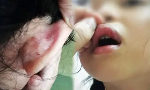 Điều tra vụ phụ huynh tố cô giáo chủ nhiệm tát chảy máu mồm học sinh vì làm toán sai