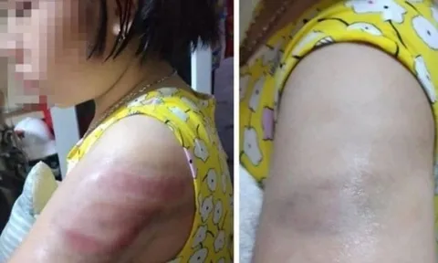 Kỷ luật cô giáo dùng thước đánh học sinh ở Nam Định