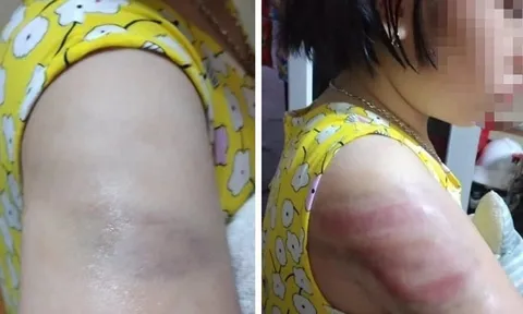 Bộ GĐ&ĐT chỉ đạo xử lý sớm vụ giáo viên đánh học sinh bầm tím tay vì viết chậm