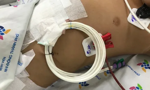 Bé trai 2,5 tuổi nhập viện cấp cứu sau khi uống nhầm hóa chất trong chai nước