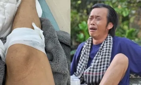 Hoài Linh bị vật nuôi 'phản chủ' đá đến bị thương băng bó ở chân