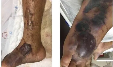 Hải Phòng: Một người đàn ông tử vong vì ăn hải sản chưa nấu chín