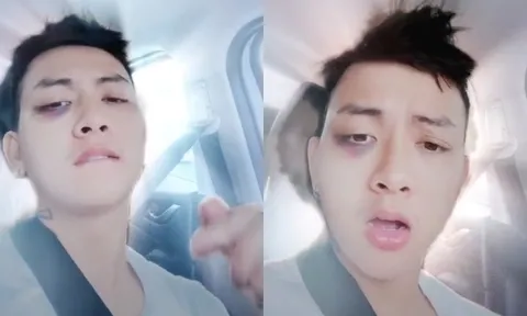 Hoài Lâm gây chú ý với gương mặt bầm tím