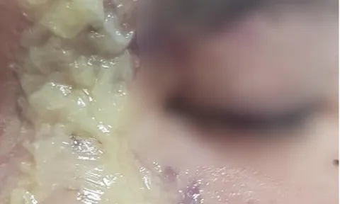 Thiếu nữ 15 tuổi bị mù vĩnh viễn sau tiêm filler nâng mũi giá 1,5 triệu