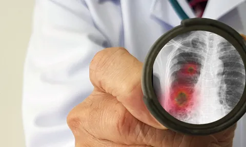 Chuyên gia Nga nêu triệu chứng tổn thương nguy hiểm nhất do virus corona mới gây ra