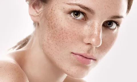 Trị nám bằng laser có tốt không?