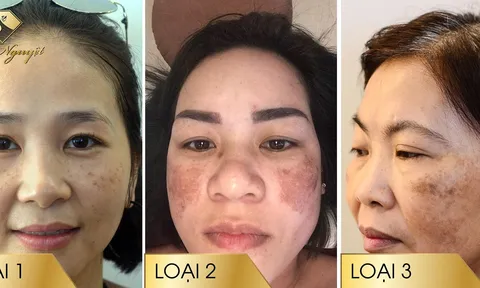 Nám hai bên gò má có chữa khỏi hoàn toàn được không?