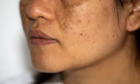 Nám da mặt lâu năm có cách nào chữa tận gốc được không?